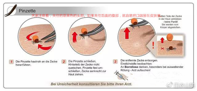 德国医生画的取蜱虫示意图。